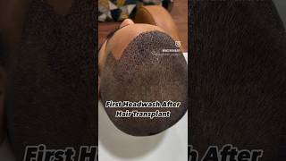 First head wash after hair transplant  Dr Nandini Dadu￼ [upl. by Hnoj]