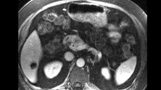 Pancreatic Adenocarcinoma [upl. by Iahc515]