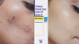 Clindamycin antibiotic  Clindamycin phosphate topical solution how  Heena Tries It  Heena [upl. by Eelamme]