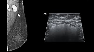 Impregnação de linfonodos axilares por silicone Achados da mamografia e da ultrassonografia [upl. by Akenot423]