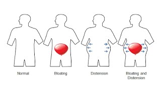 ACUPUNCTURE TREATMENT FOR ABDOMINAL DISTENTION BLOATING [upl. by Setarcos]