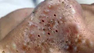 Big Cystic Acne Blackheads Extraction Blackheads amp Milia Whiteheads Removal Pimple Popping  5266 [upl. by Edmanda683]