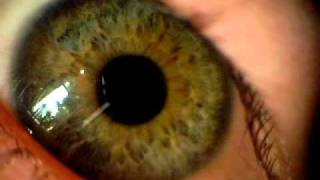 Eyeball dilation up close 2 [upl. by Khanna323]