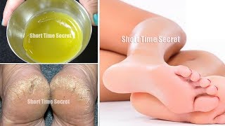 रातों रात फटी एड़ियां से छुटकारा पाये  Get Soft Smooth amp Healthy Heels in just 1 Night [upl. by Ange434]