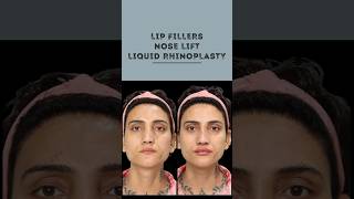 Transform Your Look Nose Lift amp Lip Fillers  Sarayu Clinics beauty [upl. by Elleirua]