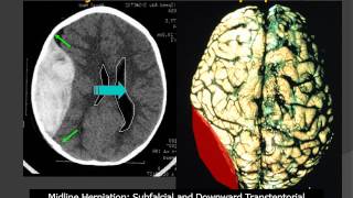 MedPix® Traumatic Brain Injury  Epidural Hematoma RadiologicPathologic Correlation [upl. by Eugenio]