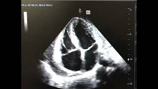 Septal bounce Constrictive Pericarditis [upl. by Anivas]