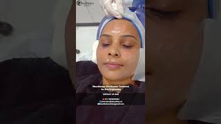 Mesotherapy Skin Booster Treatment for Skin Brightening  Facethetics Clinic [upl. by Michaeu568]