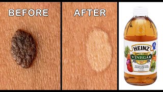 Mole Removal By Apple Cider Vinegar  Effective Ways to Remove Skin Tags Naturally [upl. by Etiuqal]