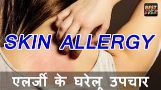 एलर्जी के घरेलू उपचार  HOME REMEDIES FOR SKIN ALLERGY [upl. by Inavihs492]