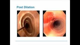 Eosinophilic Esophagitis [upl. by Alehc]