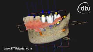 Carestream Dental CS Imaging Software 8 with CS 9600 CS 3600 implant meshing [upl. by Gyasi164]