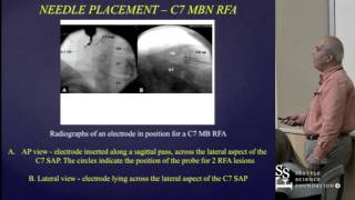 Cervical Radiofrequency Neurotomy Techniques by Mario De Pinto MD [upl. by Aissac]