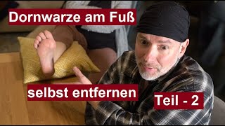 Dornwarze am Fuß selber entfernen durch vereisen  Warze Vereisung  Fußwarzen Entfernung  Teil 2 [upl. by Myrna]