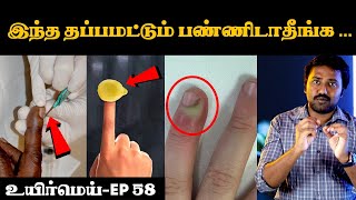 நக சுத்திக்கு சரியான தீர்வு என்ன  Cause and remedy for Nagasuthi  Uyirmei  paronychia [upl. by Ycam]