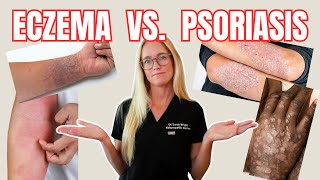 5 Key Differences Between ECZEMA vs PSORIASIS  Light Skin vs Dark Skin [upl. by Alyse]