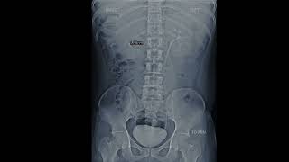 KUB X ray Show Kidney Stone aiims shortsvideo biology doctor mbbs [upl. by Esyli590]