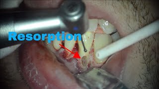 Comment traiter une résorption cervicale externe Partie 1  Approche chirurgicale [upl. by O'Callaghan]