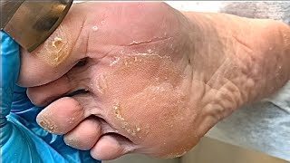 Callus removal from feetampFoot scraping dead skin【Xiao Yan pedicure】stress 19 [upl. by Peti]