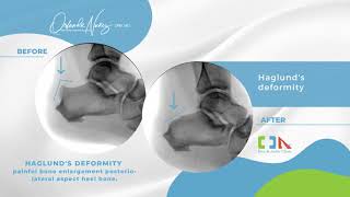 Haglunds deformity correction with Minimally Invasive Surgery [upl. by Rossi]