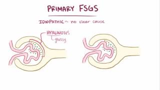 Focal segmental glomerulosclerosis causes symptoms diagnosis amp pathology [upl. by Cummine]