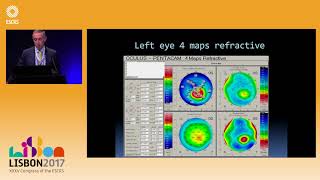 P Vinciguerra Biomechanical Characterization of Subclinical Keratoconus difficult case examples [upl. by Mccall401]