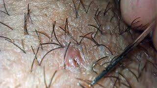 Ingrown Hair Extraction  Satisfaction  1 [upl. by Nnauol]