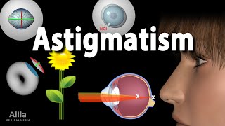 Astigmatism Types Causes Symptoms and Treatment Options Animation [upl. by Nylaret]