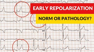 Early repolarization syndrome and pattern Norm or pathology [upl. by Novj]