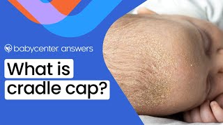 What is cradle cap [upl. by Doersten]