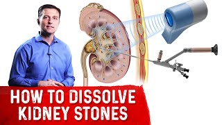 How To Dissolve Kidney Stones Explained By DrBerg [upl. by Oberheim954]