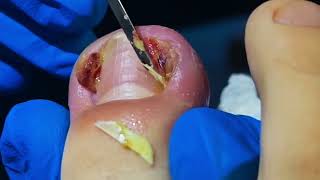 Remove a DEEP Ingrown Nail from Ugly Rotten Toenail [upl. by Eliott]