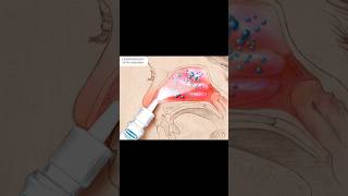 Nasonex Treatment Of Sneezing or Runny nose [upl. by Ahsieyt]