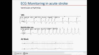 Cardiac complications in acute stroke [upl. by Storz]