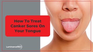 How to Treat Canker Sores on Your Tongue [upl. by Margret]