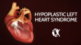 Hypoplastic Left Heart Syndrome HLHS [upl. by Rahsab196]