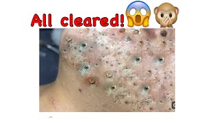 Severe acne cleared Very satisfying acne  pimple popping video satisfyingvideo pimplepopper [upl. by Shay110]