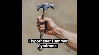 Hypothenar Hammer Syndrome [upl. by Randi941]