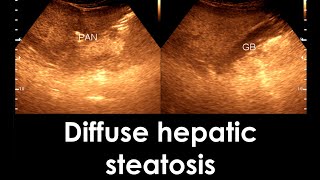 Fatty Liver  Diffuse hepatic steatosis  Liver Ultrasonogram [upl. by Enyaz]