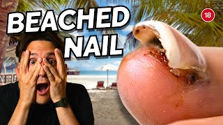 Toenail Removal After Beach Injury StepbyStep Procedure amp Care Tips [upl. by Kcirded]