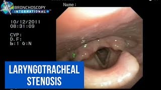 BronchAtlas Classification of Laryngotracheal Stenosis [upl. by Annalise]