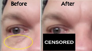 How Use Trichloroacetic Acid on Xanthelasma Spots Around Eyes at Home WARNING My BAD Experience TCA [upl. by Elrod]