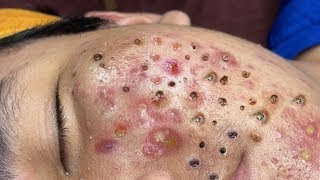 Big Cystic Acne Blackheads Extraction Blackheads amp Milia Whiteheads Removal Pimple Popping  5703 [upl. by Shir]