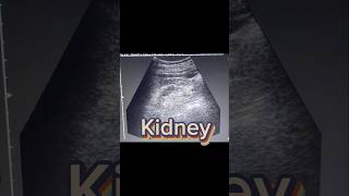 Small Kidney  cortical Thinning  Renal parenchymal Disease on Ultrasound [upl. by Petulia]