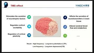 rTMS in OCD [upl. by Lorou]