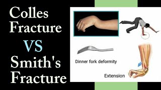 Colles Fracture VS Smiths Fracture II Timesphysio [upl. by Klusek]