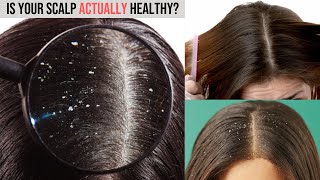 How to Treat Dandruff Dermatitis or Scalp Psoriasis  Causes Symptoms and Treatments [upl. by Giffer334]