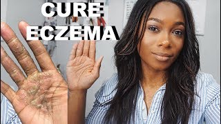 How I Cured My Eczema Fast  Trishonnastrends [upl. by Telracs]