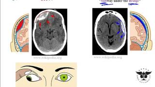 Hemorrhagic stroke epidural amp subdural hematoma  USMLE Step 1 [upl. by Albrecht612]