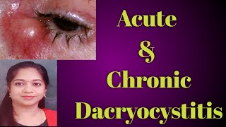 Dacryocystitis  Acute dacryocystitis Chronic Dacryocystitis Stages of Dcryocystitis Mucocele [upl. by Bridget876]